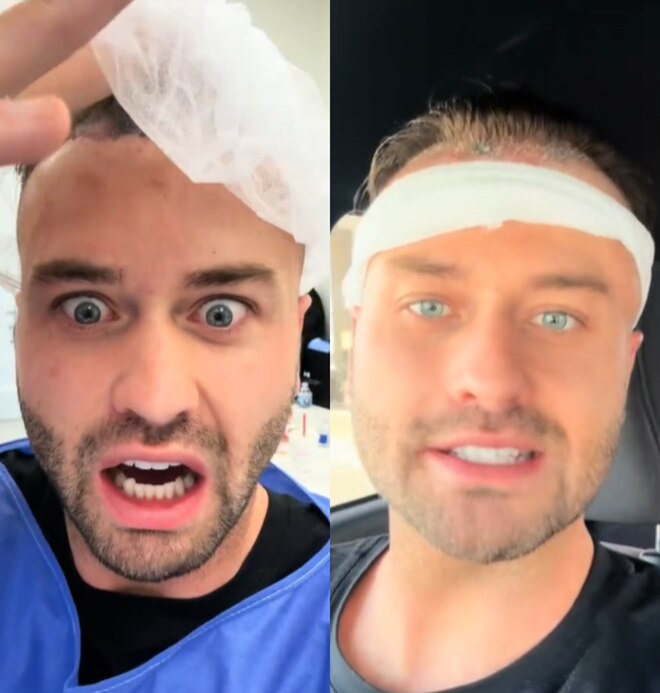 Mormon Wives’ Dakota Mortensen Details “Crazy” Hair Transplant Journey